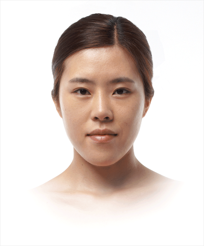 類型別両顎手術 韓国バノバギの両顎手術は安全です D