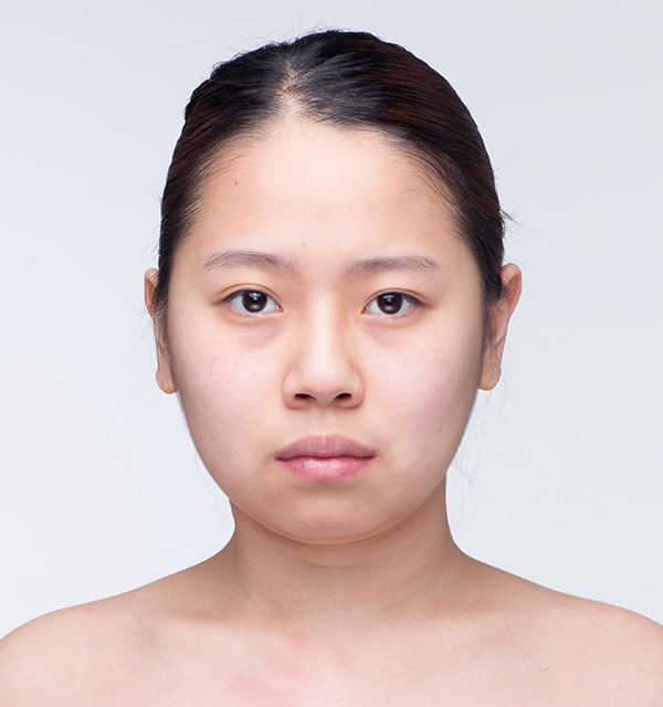 目つき矯正 韓国美容整形のバノバギ美容整形外科