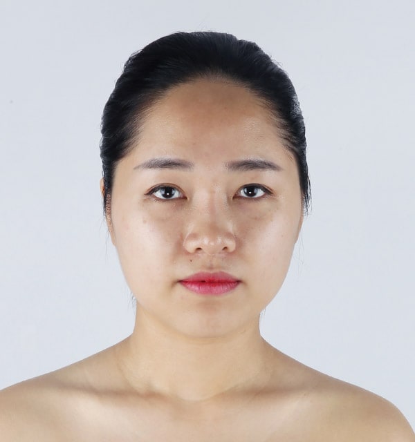 切開法 二重整形 韓国美容整形のバノバギ美容整形外科
