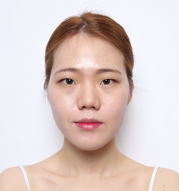 韓国の美容整形のフォトギャラリー 韓国バノバギ美容整形外科