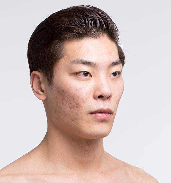 頬骨縮小術 頬骨形成 輪郭 韓国美容整形のバノバギ美容整形外科