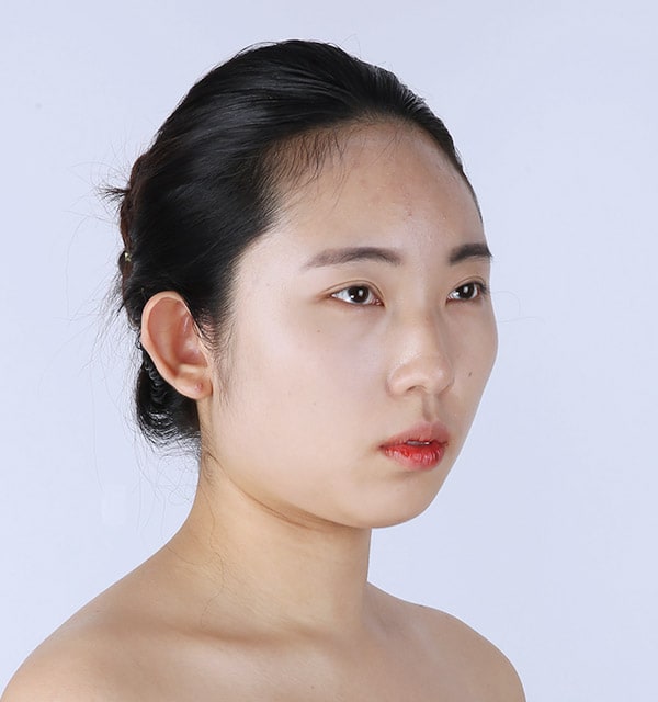 低い鼻 鼻を高くする 鼻の形を変える美容整形手術 韓国バノバギ美容整形外科